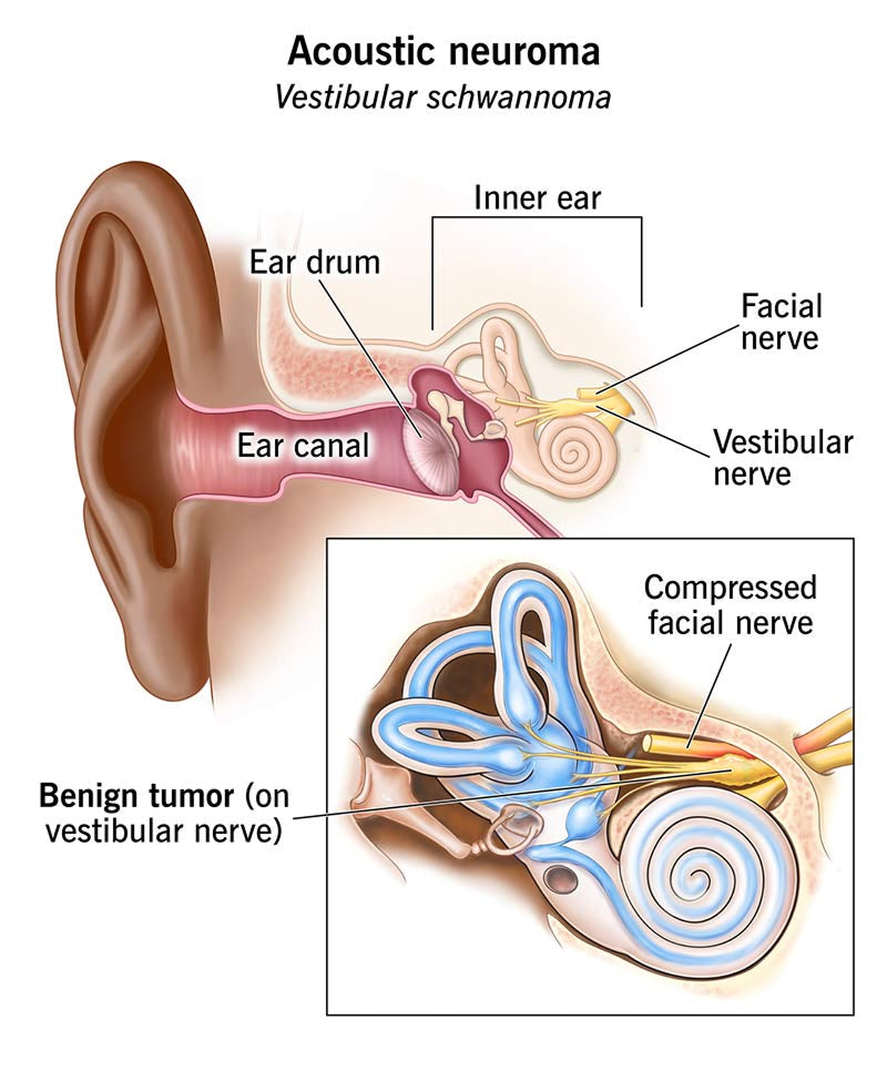 Understanding Acoustic Neuroma