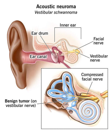 Understanding Acoustic Neuroma