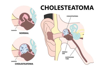 Understanding Cholesteatoma